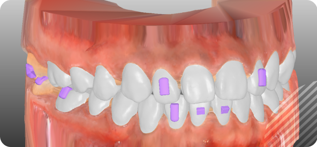 Close-up of a 3D model showing orthodontic brackets attached to teeth.