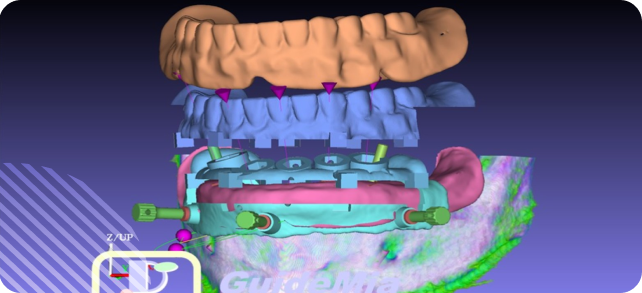 3D visualization of advanced orthodontic treatment planning with various dental tools and components.