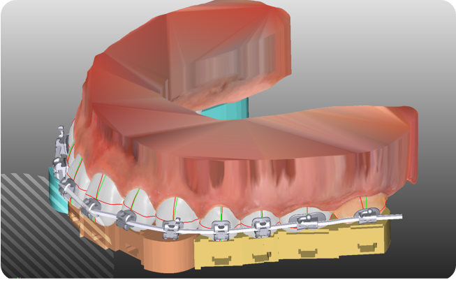 3D rendering of dental braces on upper and lower teeth.