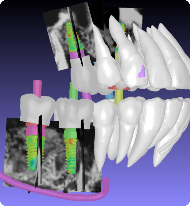 3D rendering of dental implants with analytical data overlays.