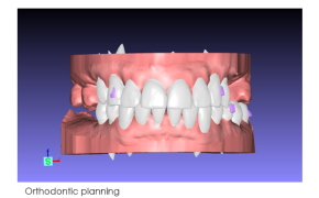 3D digital model of upper teeth set used in orthodontic planning, with purple markers on specific teeth for precise adjustments.