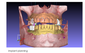 3D visualization of dental implant planning showing an anatomically correct human jaw with marked teeth for implant sites.