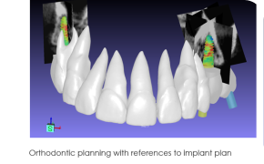 3D dental model showing upper teeth with colored references for orthodontic planning and implant areas, featuring a directional label in the bottom left corner.