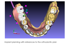 3D model of a dental arch with implant planning markers.