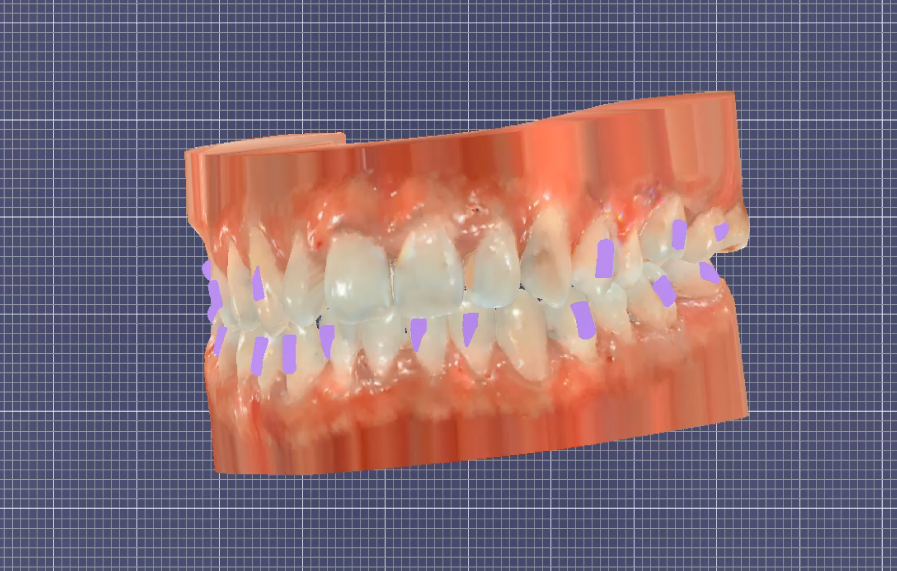 3D dental model showcasing treatment planning with translucent teeth and adjustment markers.