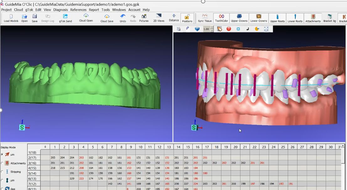 Dual-view within GuideMia software displaying 3D dental models, one in green showing top teeth and the other showing a full set with brackets and measurements.