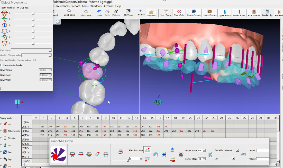 Screenshot of dental orthodontic planning software, showing detailed 3D models of teeth with adjustment tools and measurement data