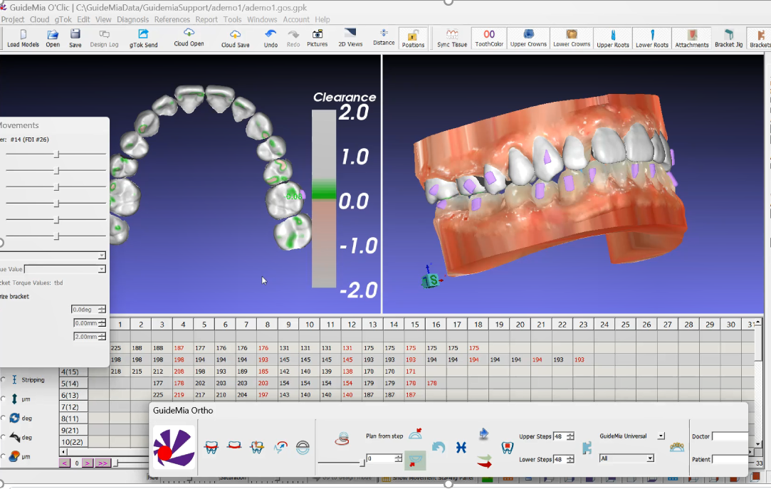 Dual-screen dental software interface showing 3D models of teeth with detailed measurements and clearance levels for treatment planning.