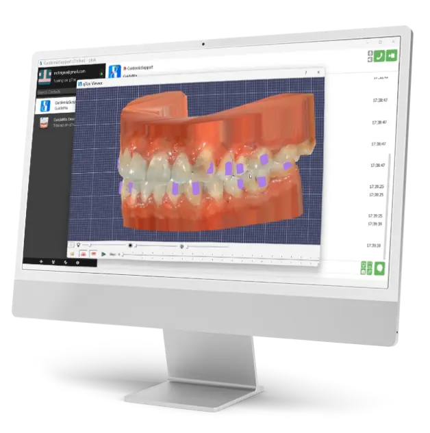 Computer monitor displaying a 3D model of a dental arch with orthodontic brackets in GuideMia software.